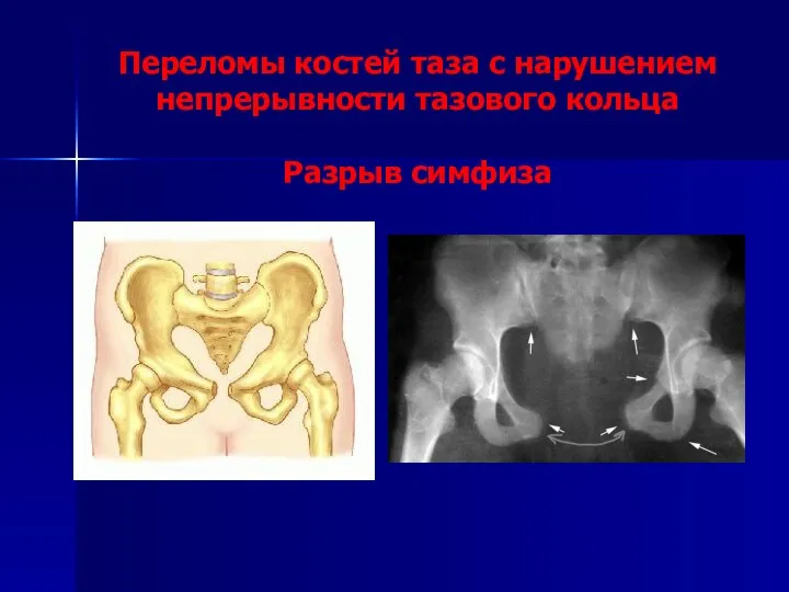 Переломы костей таза с нарушением непрерывности тазового кольца Разрыв симфиза