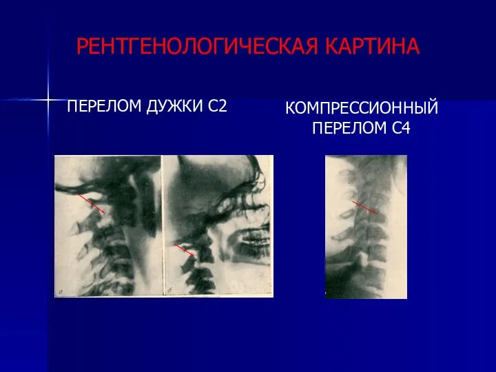 РЕНТГЕНОЛОГИЧЕСКАЯ КАРТИНА ПЕРЕЛОМ ДУЖКИ С2 КОМПРЕССИОННЫЙ ПЕРЕЛОМ С4