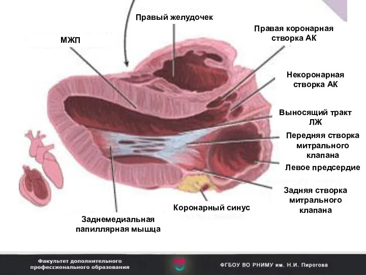 МЖП Правый желудочек Правая коронарная створка АК Некоронарная створка АК Заднемедиальная