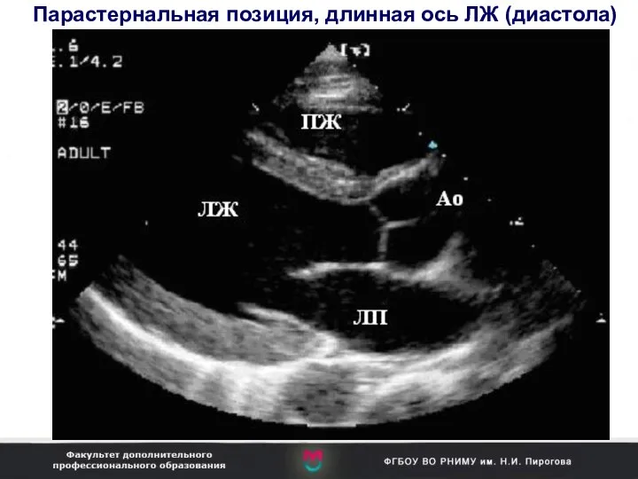 Парастернальная позиция, длинная ось ЛЖ (диастола)