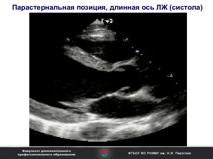 Парастернальная позиция, длинная ось ЛЖ (систола)