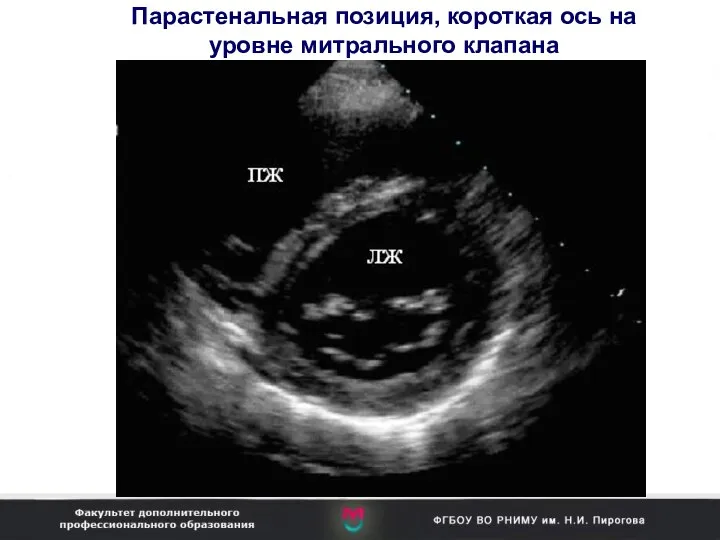 Парастенальная позиция, короткая ось на уровне митрального клапана