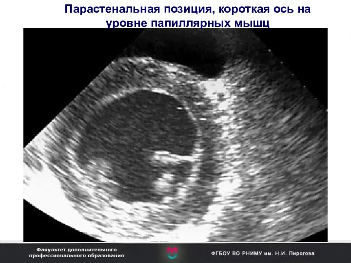 Парастенальная позиция, короткая ось на уровне папиллярных мышц