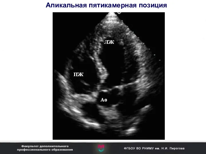 Апикальная пятикамерная позиция