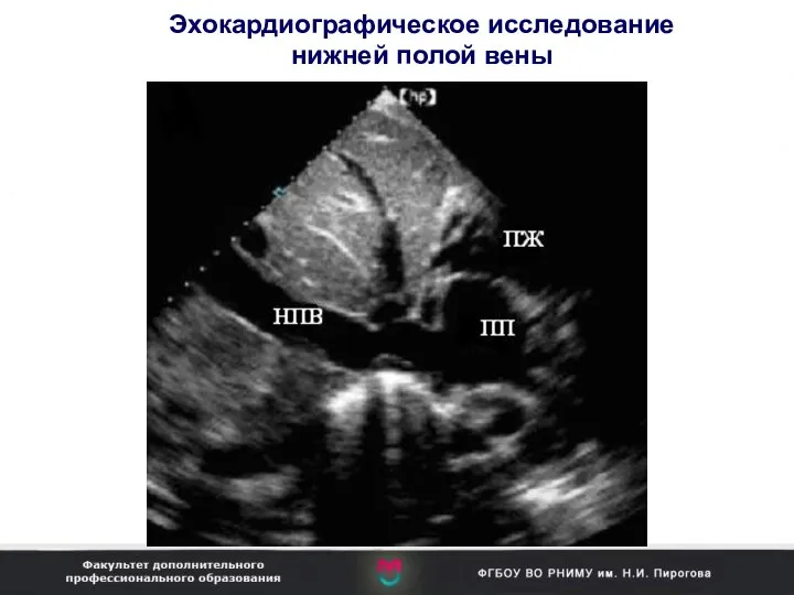 Эхокардиографическое исследование нижней полой вены