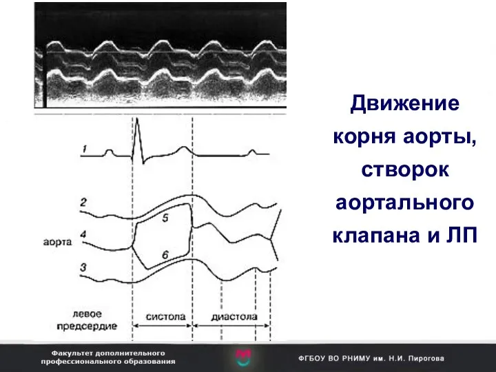 Движение корня аорты, створок аортального клапана и ЛП