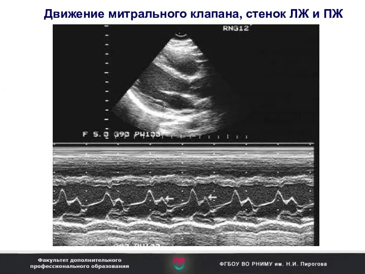 Движение митрального клапана, стенок ЛЖ и ПЖ