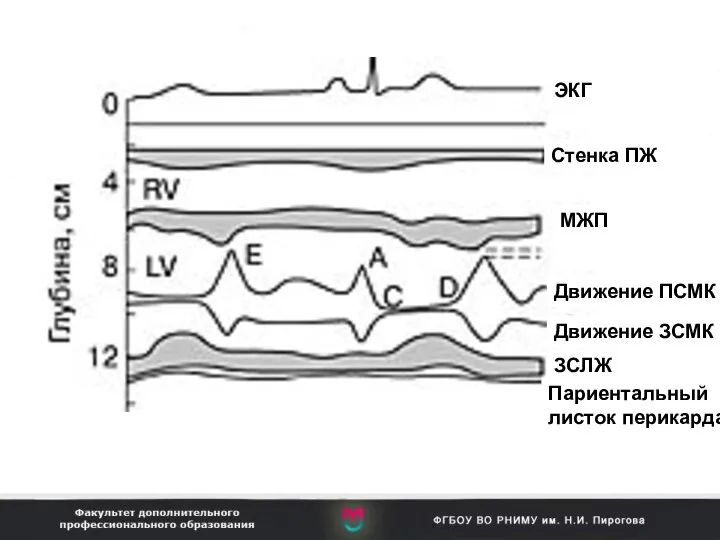 ЭКГ Стенка ПЖ МЖП Движение ПСМК Движение ЗСМК ЗСЛЖ Париентальный листок перикарда