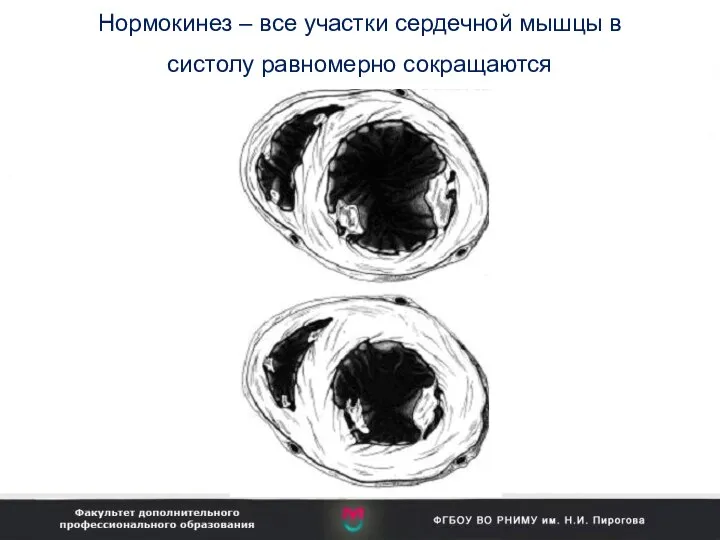 Нормокинез – все участки сердечной мышцы в систолу равномерно сокращаются