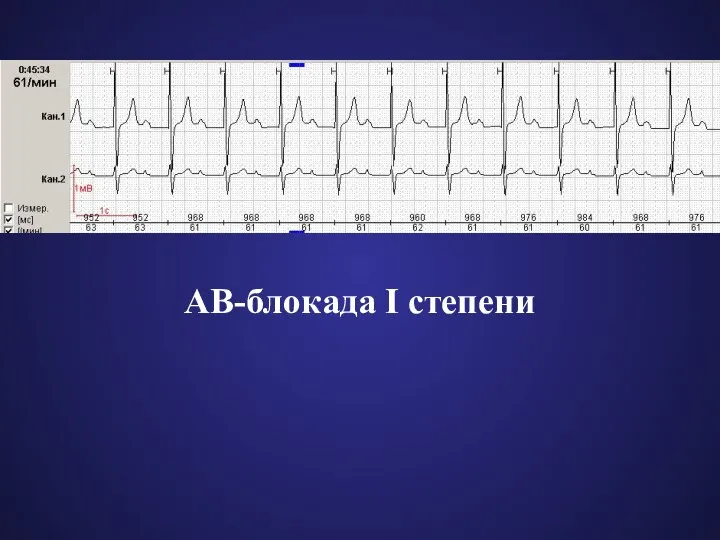 АВ-блокада I степени