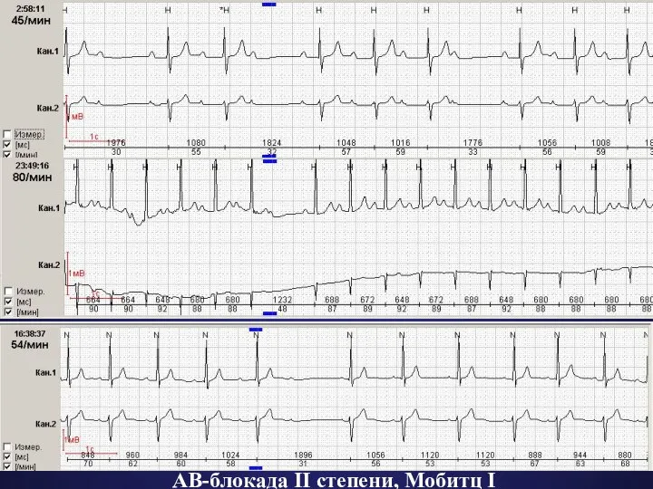 АВ-блокада II степени, Мобитц I