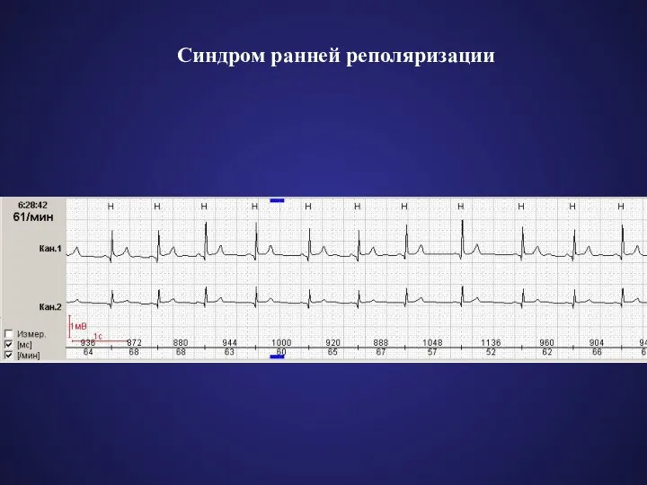 Синдром ранней реполяризации
