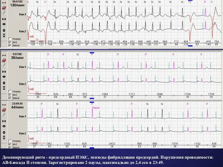 Доминирующий ритм - предсердный ПЭКС, эпизоды фибрилляции предсердий. Нарушения проводимости: АВ-блокада