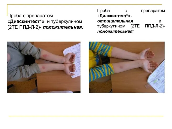 Проба с препаратом «Диаскинтест*» и туберкулином (2ТЕ ППД-Л-2)- положительная: Проба с