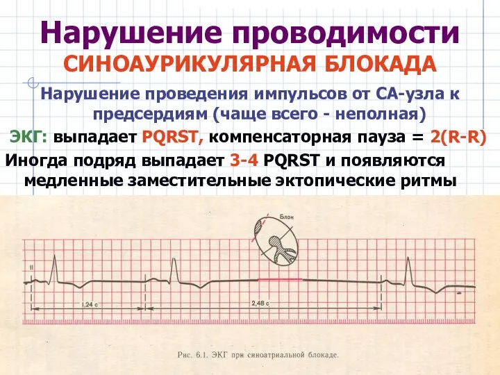 Нарушение проводимости СИНОАУРИКУЛЯРНАЯ БЛОКАДА Нарушение проведения импульсов от СА-узла к предсердиям