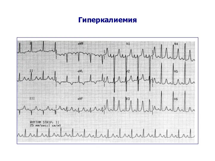 Гиперкалиемия