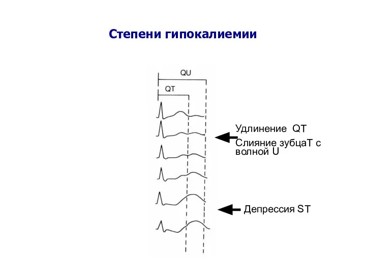 Степени гипокалиемии Удлинение QT Слияние зубцаT с волной U Депрессия ST