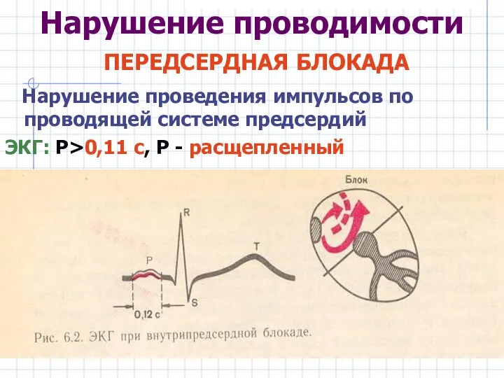 Нарушение проводимости ПЕРЕДСЕРДНАЯ БЛОКАДА Нарушение проведения импульсов по проводящей системе предсердий