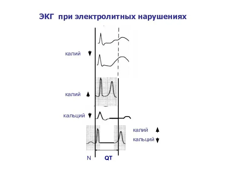 ЭКГ при электролитных нарушениях N QT калий калий кальций калий кальций