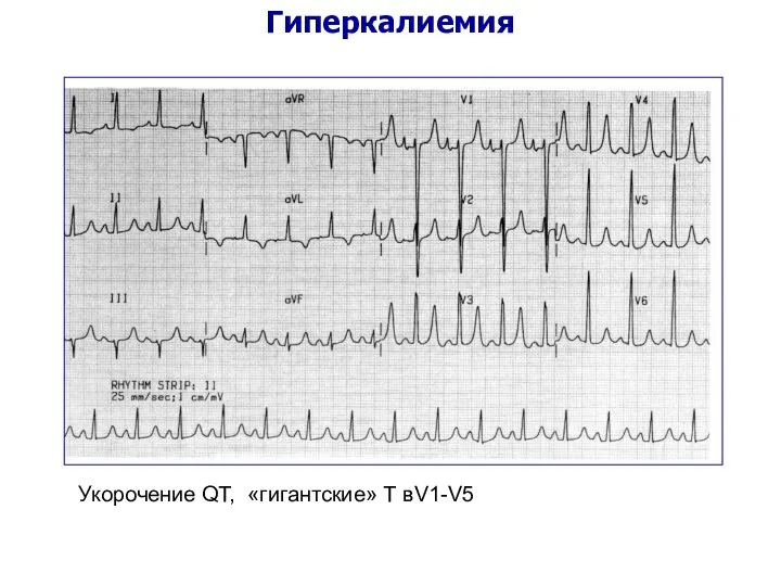 Гиперкалиемия Укорочение QT, «гигантские» Т вV1-V5