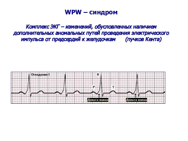 WPW – синдром Комплекс ЭКГ – изменений, обусловленных наличием дополнительных аномальных