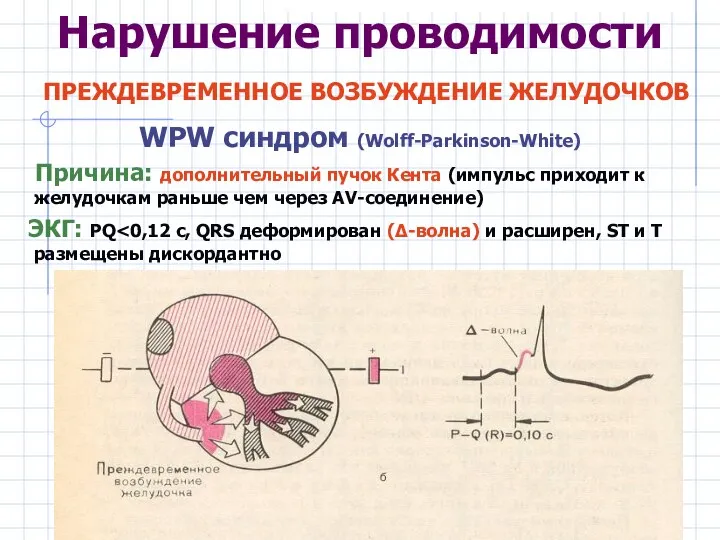 Нарушение проводимости ПРЕЖДЕВРЕМЕННОЕ ВОЗБУЖДЕНИЕ ЖЕЛУДОЧКОВ WPW синдром (Wolff-Parkinson-White) Причина: дополнительный пучок