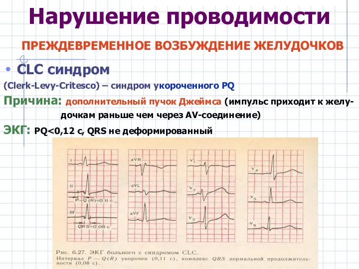 Нарушение проводимости ПРЕЖДЕВРЕМЕННОЕ ВОЗБУЖДЕНИЕ ЖЕЛУДОЧКОВ CLC синдром (Clerk-Levy-Critesco) – синдром укороченного