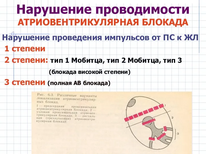 Нарушение проводимости АТРИОВЕНТРИКУЛЯРНАЯ БЛОКАДА Нарушение проведения импульсов от ПС к ЖЛ