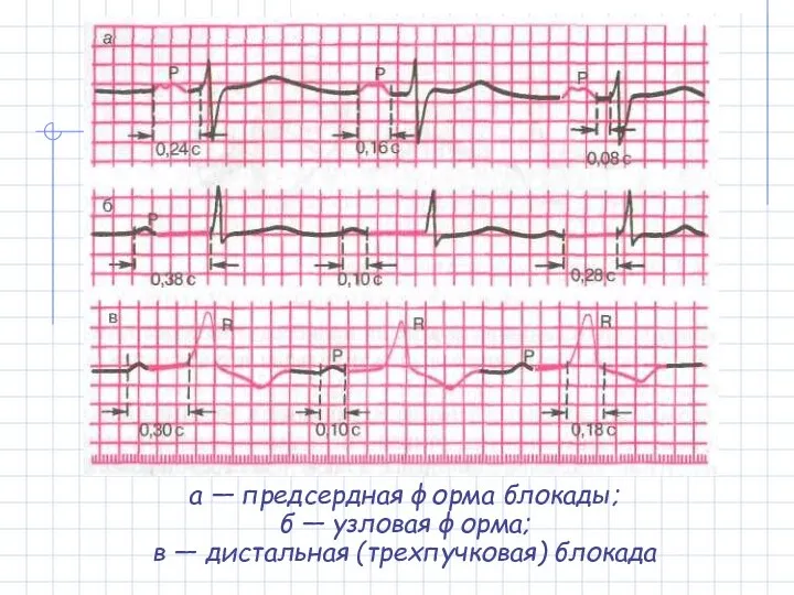 а — предсердная форма блокады; б — узловая форма; в — дистальная (трехпучковая) блокада