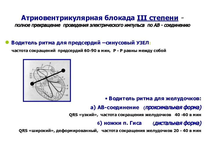 Атриовентрикулярная блокада III степени - полное прекращение проведения электрического импульса по