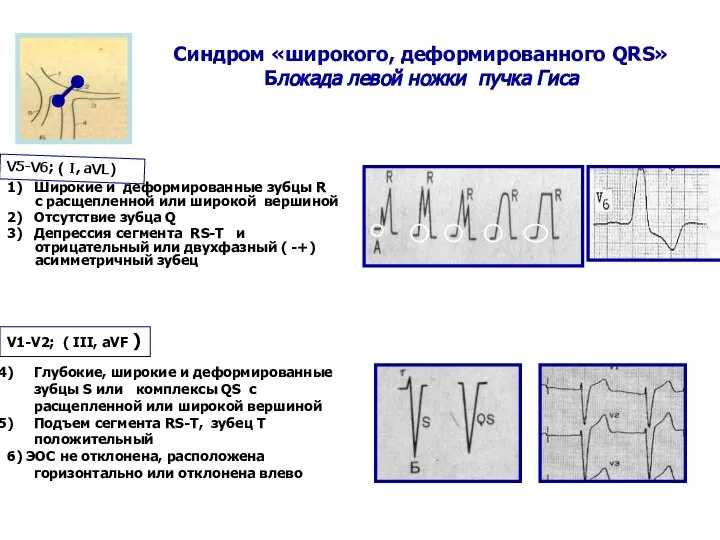 Синдром «широкого, деформированного QRS» Блокада левой ножки пучка Гиса 1) Широкие