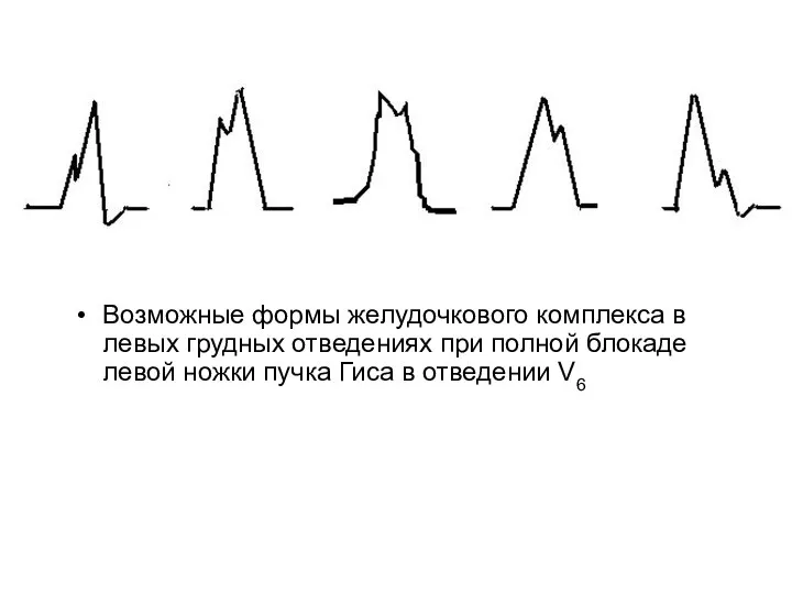 Возможные формы желудочкового комплекса в левых грудных отведениях при полной блокаде