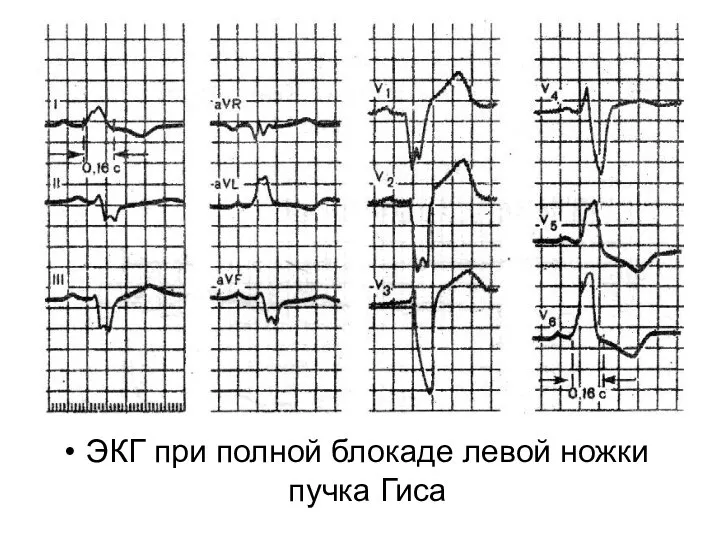 ЭКГ при полной блокаде левой ножки пучка Гиса