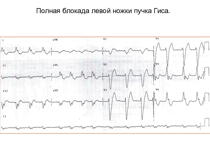 Полная блокада левой ножки пучка Гиса.