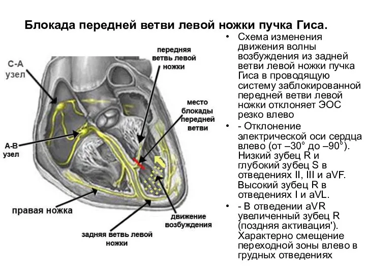 Блокада передней ветви левой ножки пучка Гиса. Схема изменения движения волны