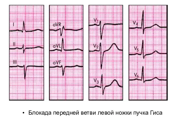 Блокада передней ветви левой ножки пучка Гиса