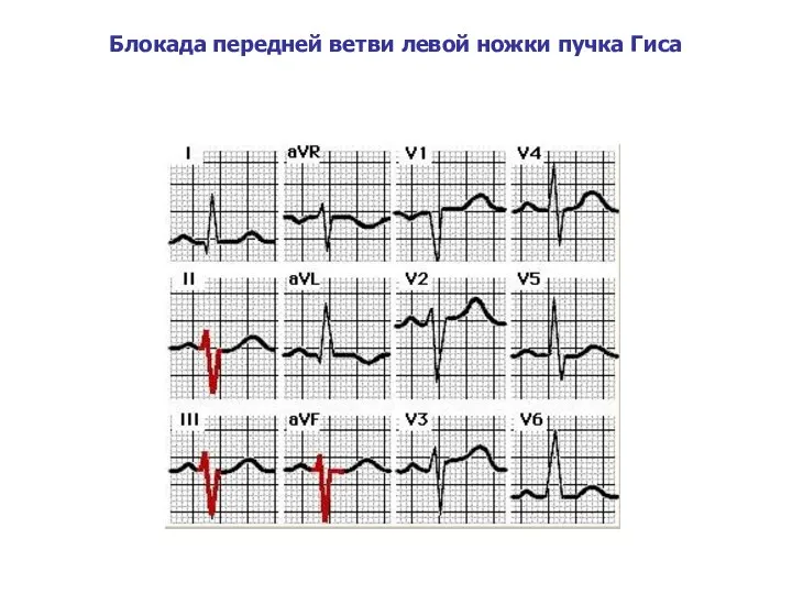 Блокада передней ветви левой ножки пучка Гиса