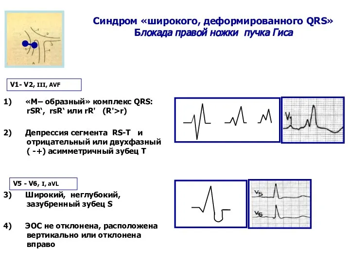 Синдром «широкого, деформированного QRS» Блокада правой ножки пучка Гиса 1) «М–