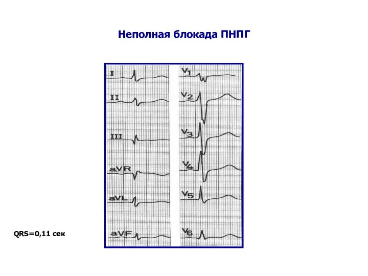 Неполная блокада ПНПГ QRS=0,11 сек