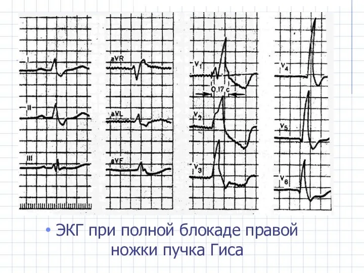 ЭКГ при полной блокаде правой ножки пучка Гиса