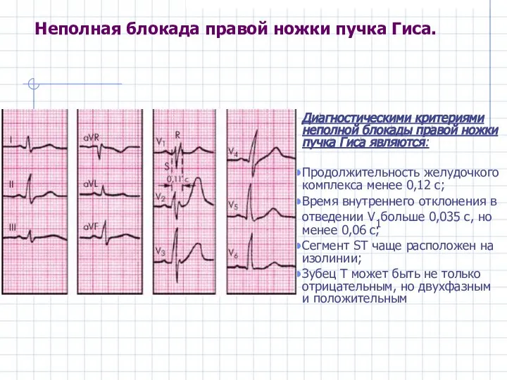 Неполная блокада правой ножки пучка Гиса. Диагностическими критериями неполной блокады правой