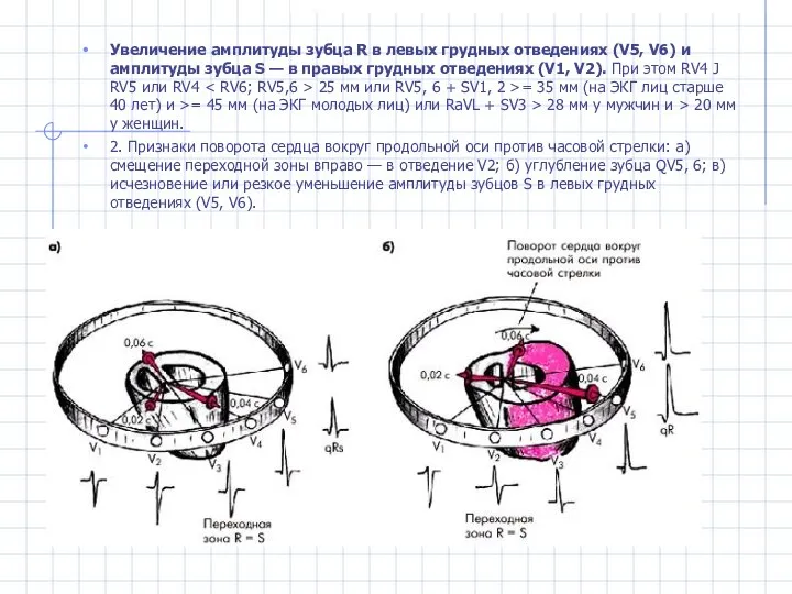 Увеличение амплитуды зубца R в левых грудных отведениях (V5, V6) и