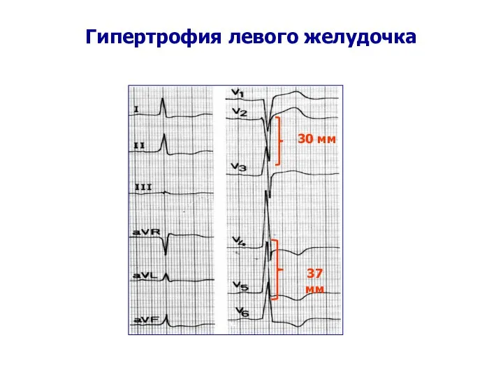 Гипертрофия левого желудочка 30 мм 37 мм