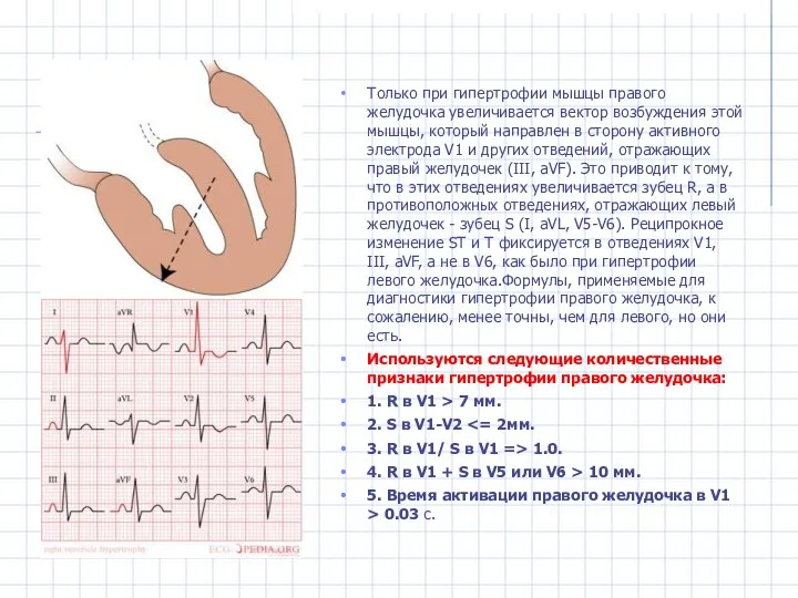 Только при гипертрофии мышцы правого желудочка увеличивается вектор возбуждения этой мышцы,