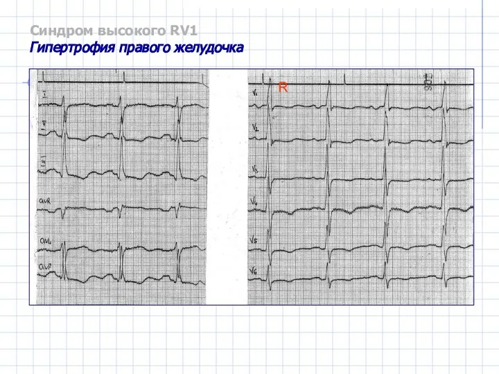 Синдром высокого RV1 Гипертрофия правого желудочка R
