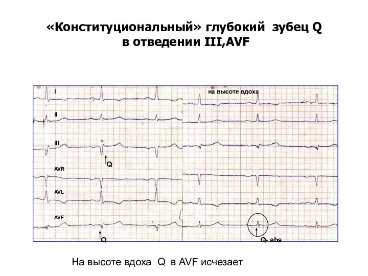 «Конституциональный» глубокий зубец Q в отведении III,AVF I II III AVR