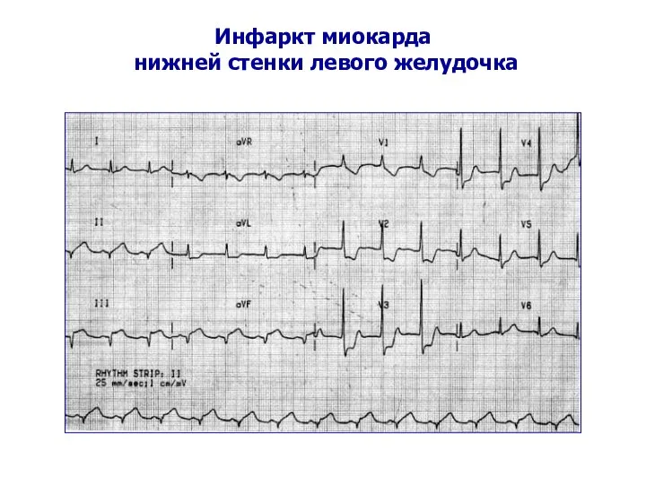 Инфаркт миокарда нижней стенки левого желудочка