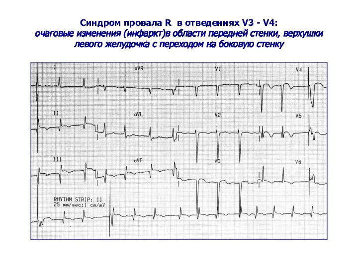 Синдром провала R в отведениях V3 - V4: очаговые изменения (инфаркт)в