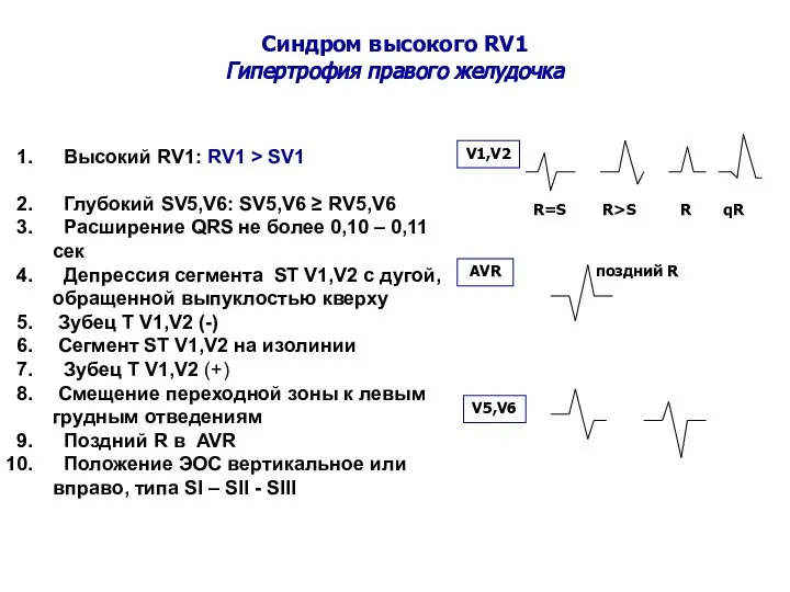 Синдром высокого RV1 Гипертрофия правого желудочка Высокий RV1: RV1 > SV1