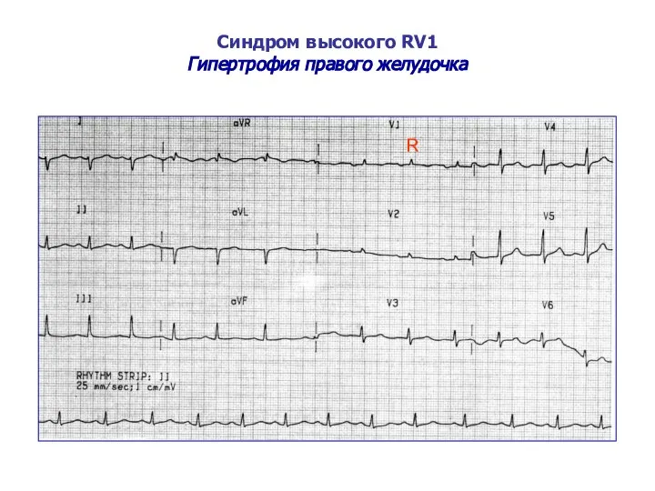 Синдром высокого RV1 Гипертрофия правого желудочка R